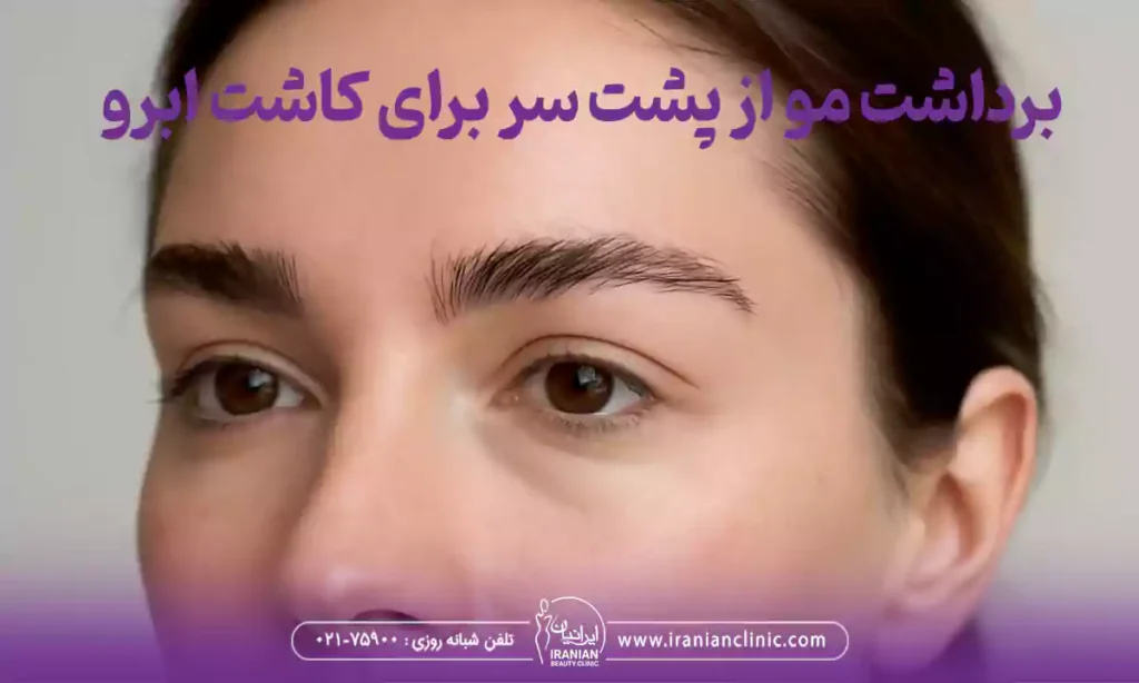 برداشت مو از پشت سر برای کاشت ابرو