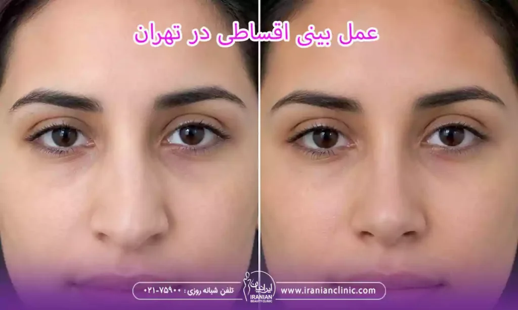 عمل بینی اقساطی و عمل قسطی بینی در تهران